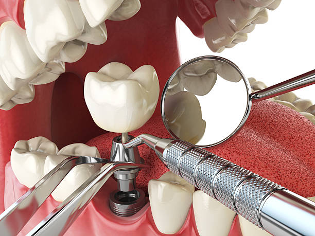 Best Emergency Broken Tooth Repair in Vail, CO
